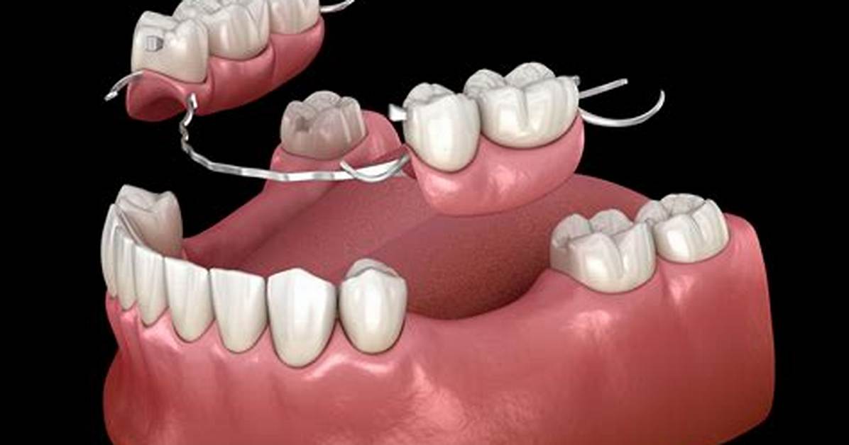 Do Partials Fall out?