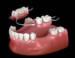 Do Partials Fall out?