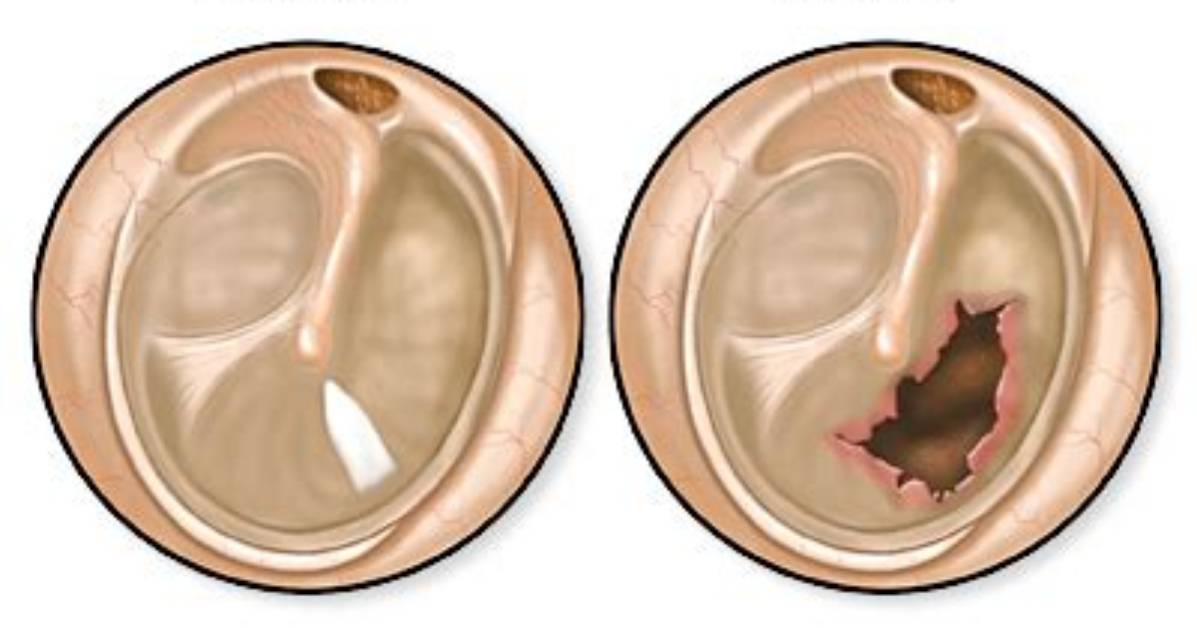 Do Perforated Eardrums Bleed?