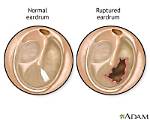 Do Perforated Eardrums Bleed?
