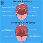 Do Peritonsillar Abscess Hurt?