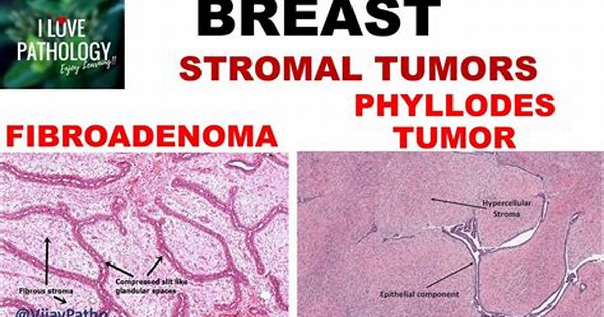 Do Phyllodes Tumors Move?