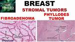 Do Phyllodes Tumors Move?