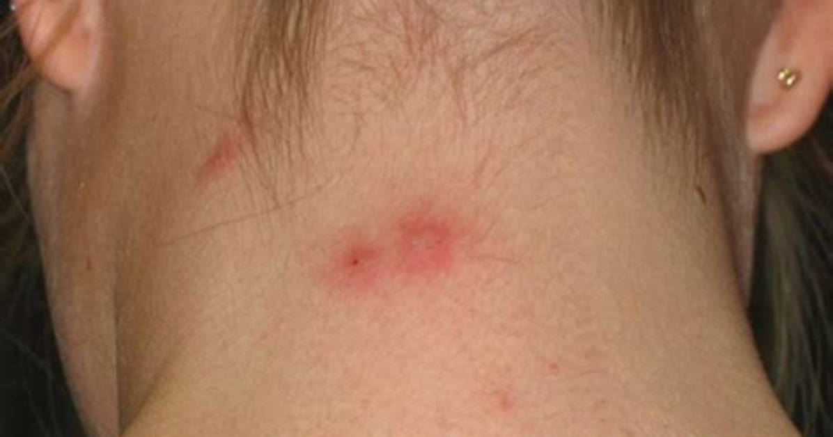 Do Pincher Bugs Bite?
