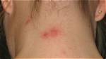 Do Pincher Bugs Bite?