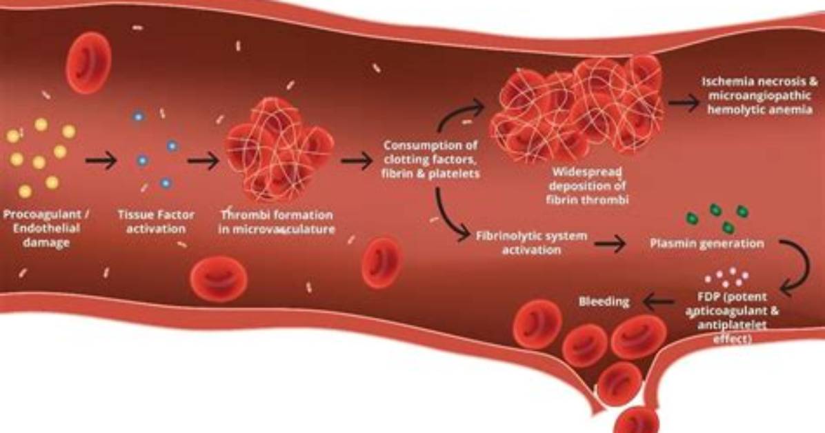 Do Platelets Increase in Dic?