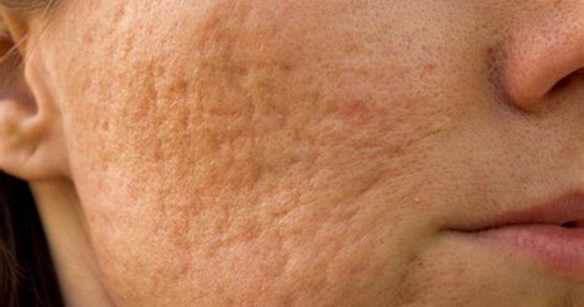 Do Pockmarks Go Away?