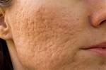 Do Pockmarks Go Away?