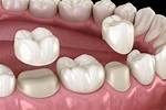 Do Premolars Need Crowns?