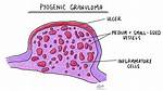 Do Pyogenic Granulomas Fall off?