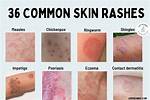 Do Rashes Spread When You Scratch?