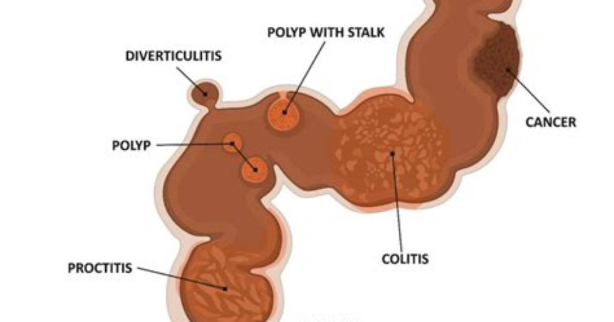 Do Rectal Polyps Bleed?