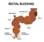 Do Rectal Polyps Bleed?