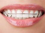 Do Retainers Straighten Teeth?