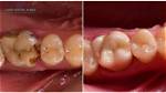 Do Rotten Teeth Hurt?