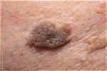 Do Senile Warts Bleed?