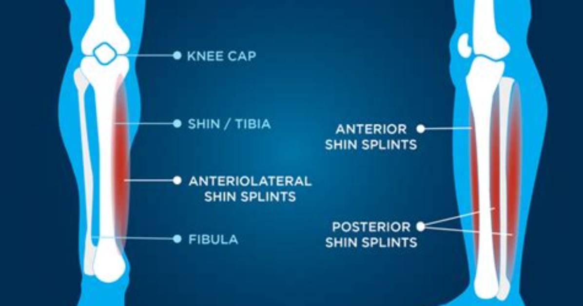 Do Shin Splints Throb?