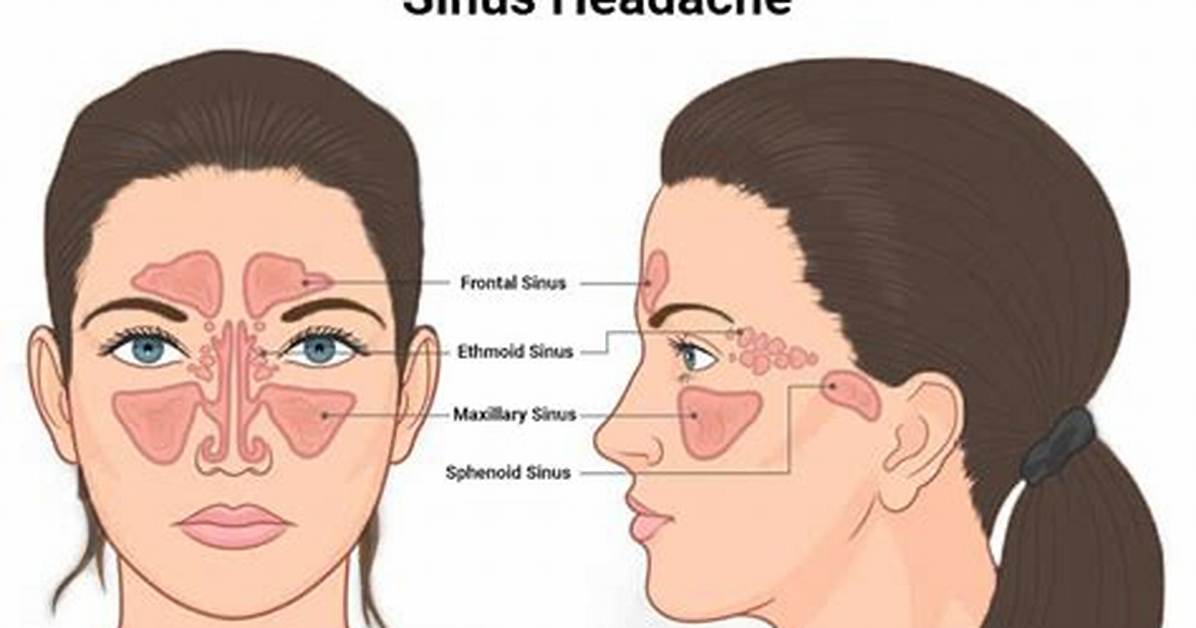 Do Sinuses Cause Headaches?