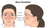 Do Sinuses Cause Headaches?