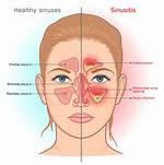 Do Sinusitis Cause Laryngitis?