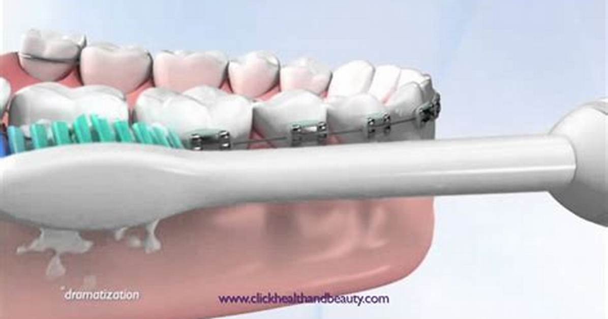 Do Sonicare Toothbrushes Work?