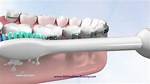 Do Sonicare Toothbrushes Work?
