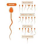 Do Sperm Abnormalities Cause Birth Defects?