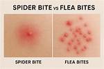 Do Spider Bites Blister?