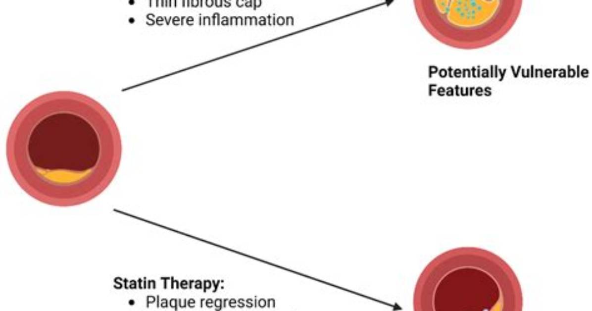 Do Statins Cause Capsulitis?