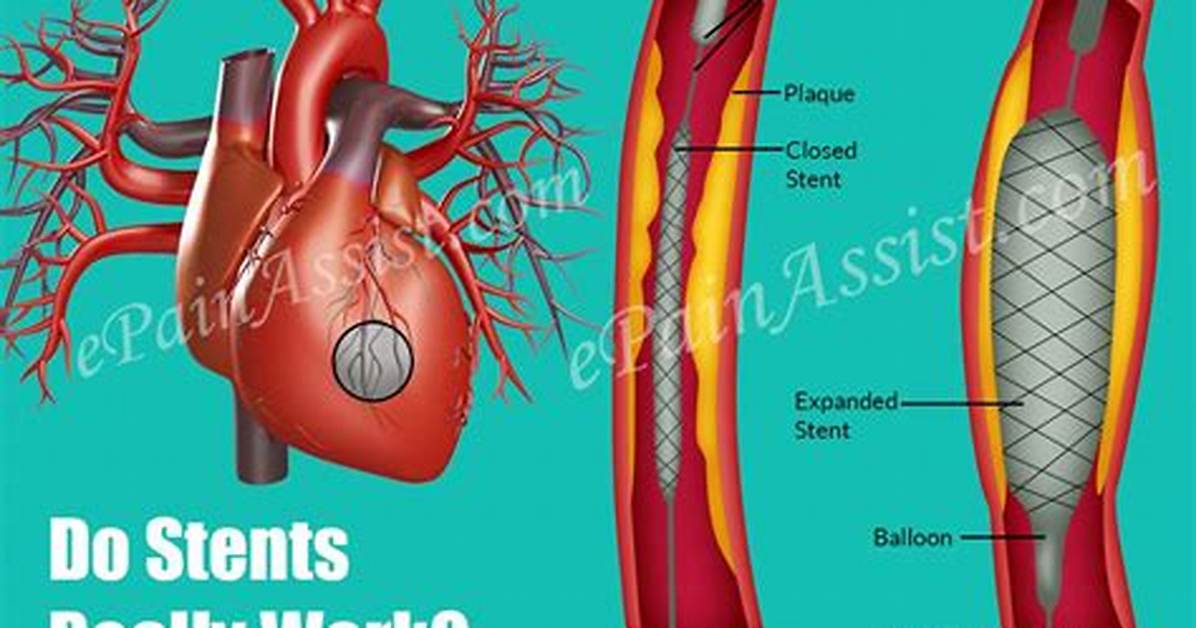Do Stents Really Work?