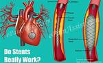 Do Stents Really Work?