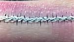 Do Stitches Dissolve