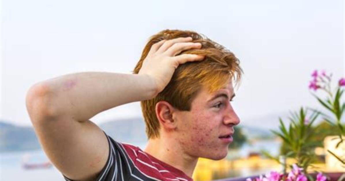 Do Sun Clears Acne?