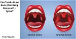 Do Tonsils Grow Back?