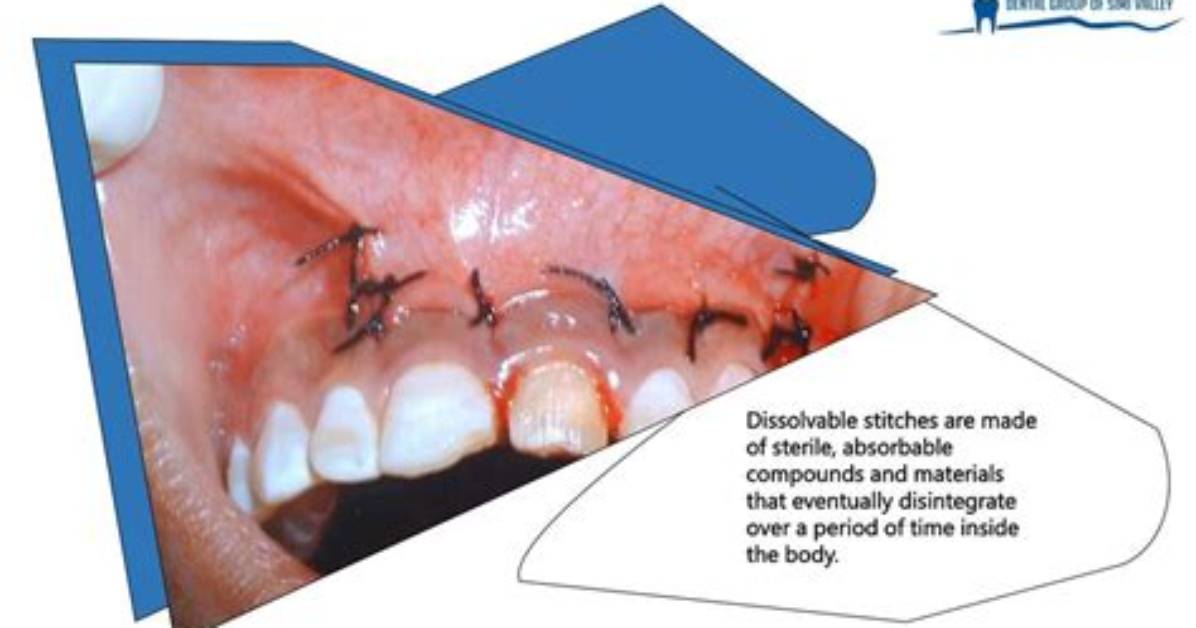 Do Tooth Extraction Stitches Dissolve?