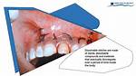 Do Tooth Extraction Stitches Dissolve?