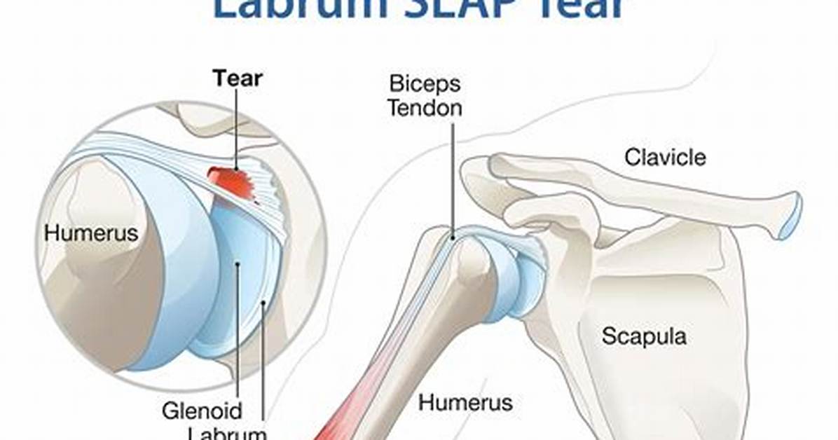 Do Torn Labrums Hurt?