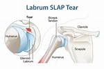Do Torn Labrums Hurt?