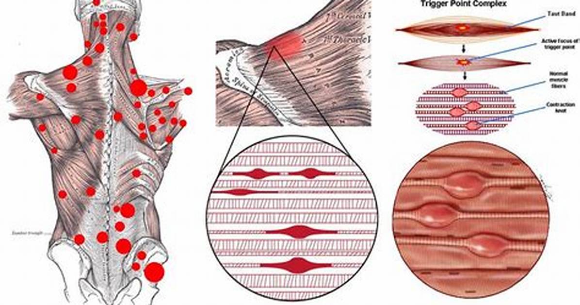 Do Trigger Points Go Away?
