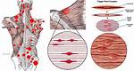 Do Trigger Points Go Away?