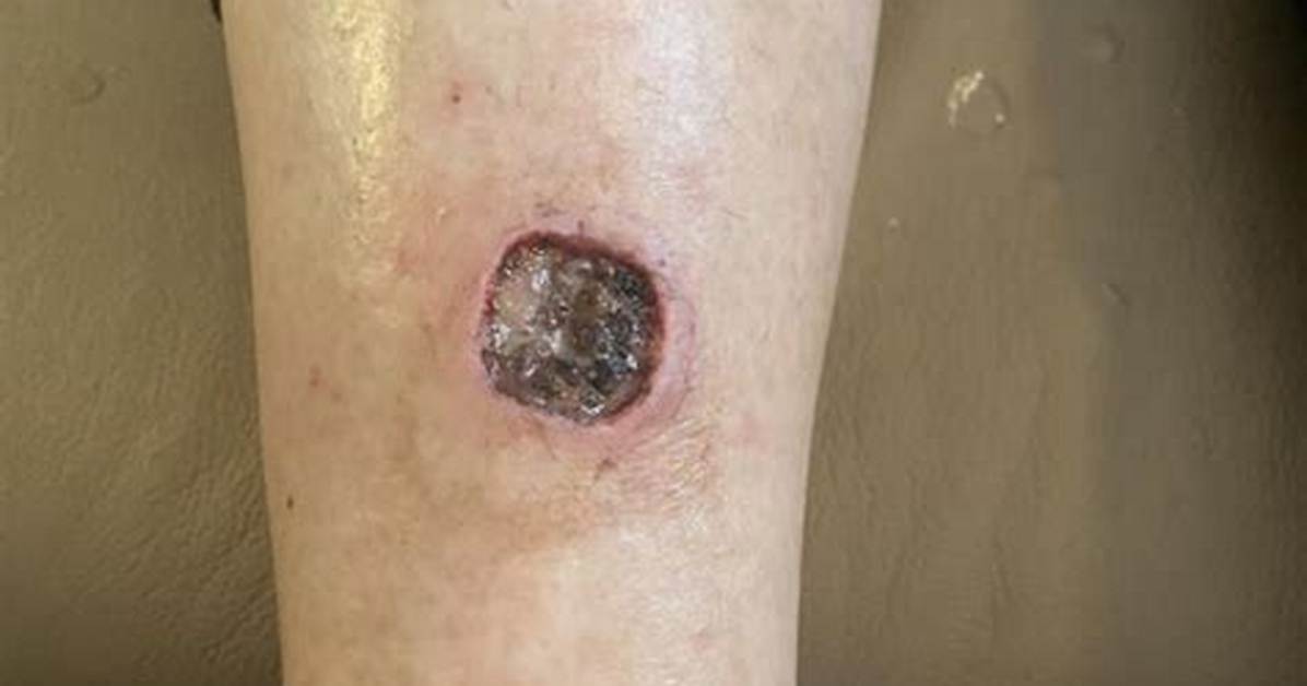 Do Ulcers Scab Over