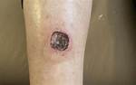 Do Ulcers Scab Over