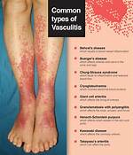 Do Vasculitis Rashes Itch?