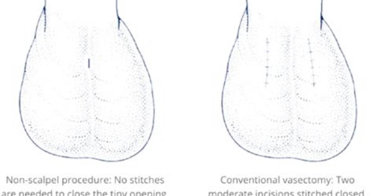 Do Vasectomy Stitches Dissolve?