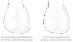 Do Vasectomy Stitches Dissolve?
