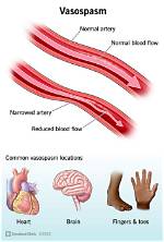 Do Vasospasms Go Away?