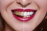 Do Veneers Last Forever?