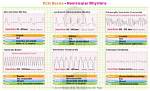 Do Ventricular Rhythms Have P Waves?