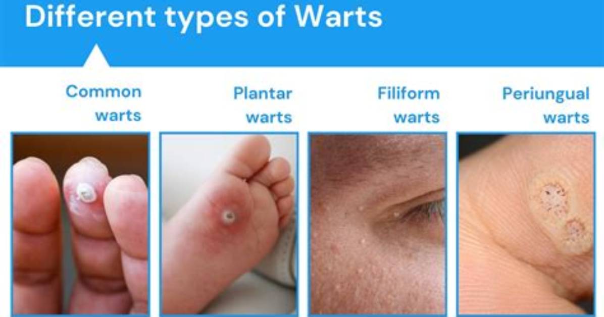 Do Warts Bleed When Picked?