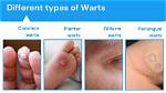 Do Warts Bleed When Picked?